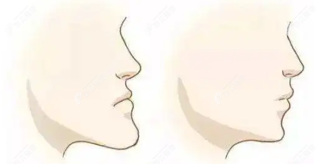 月亮脸和正常脸型的区别对比