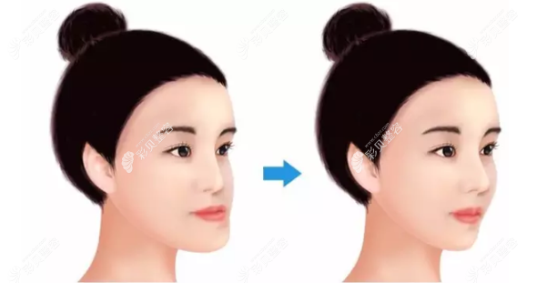 月亮脸矫正的前后对比