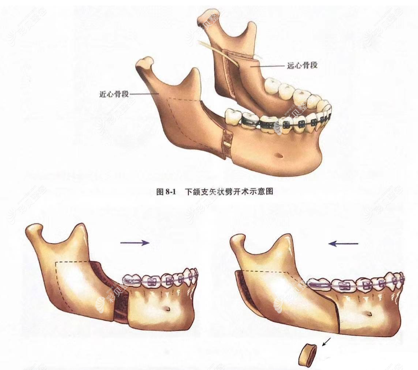 月亮脸矫正方法
