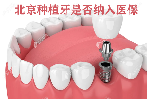 北京种植牙是否已纳入医 保政策