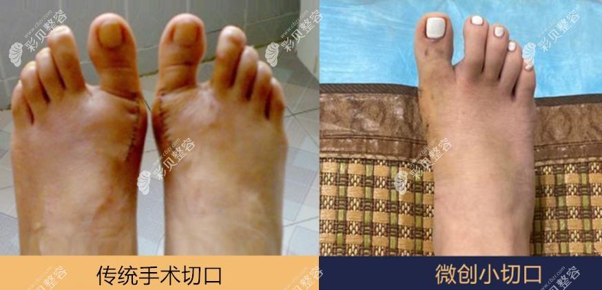 成人拇外翻矫正微创手术和传统手术哪个好