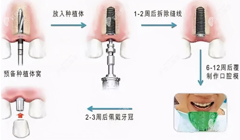 种植牙手术过程