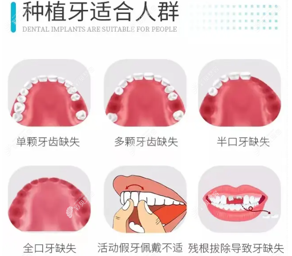 哪些人适合进行种植牙手术
