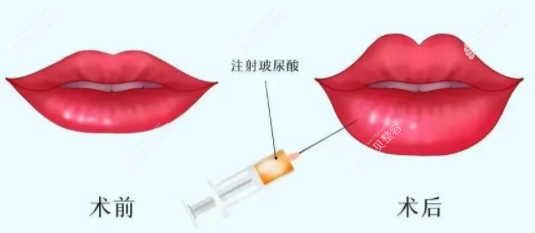 唇部玻尿酸填充前后对比图