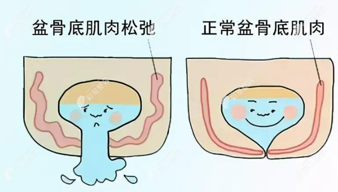 产后漏尿是什么原因造成的