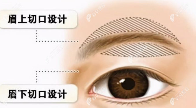 提眉的两个切口