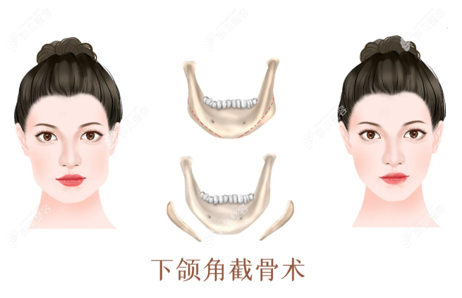 广州广大下颌角价格表:看长曲线下颌角比普通截骨贵多少钱