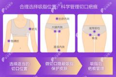 ​北京润美玉之光吸脂价格(含大腿腰腹脸部)及用的吸脂仪器