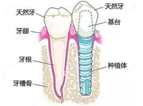 种植牙和真牙的区别www.cbzr.com