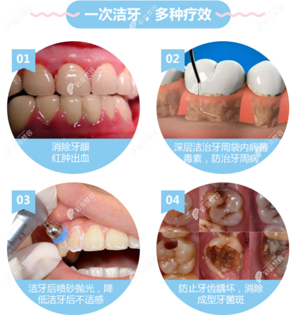 麦芽口腔洁牙