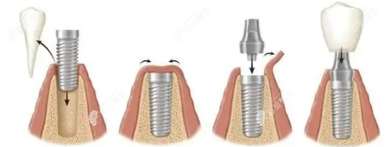 昆明美奥口腔做种植牙手术流程