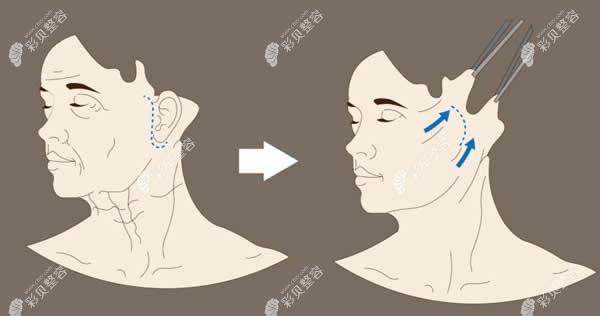 广州韩妃整形医院面部拉皮除皱前后对比图