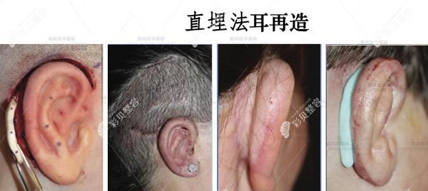 耳再造直埋法二期手术过程图解 耳再造直埋法二期手术过程图解