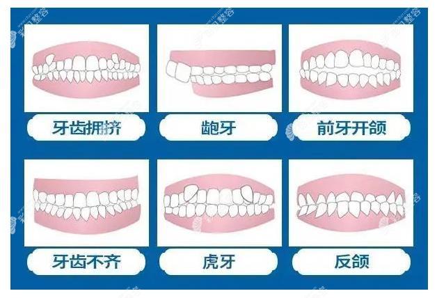 佛山登特口腔牙齿矫正多少钱