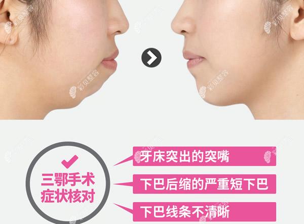 韩国必妩整形医院三鄂手术图片