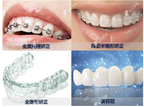 不同的牙齿矫正材料www.cbzr.com