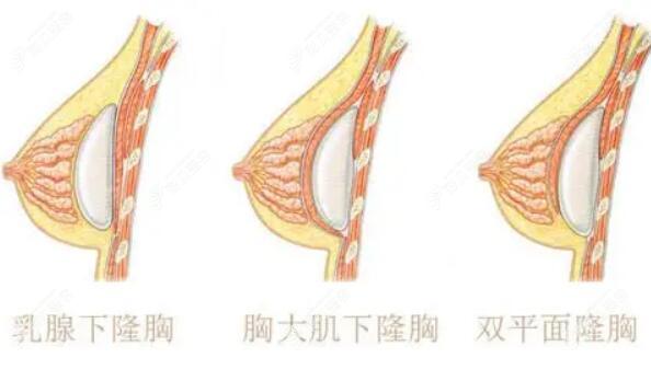 隆胸假体放置位置层次