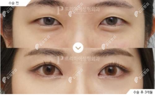 韩国普瑞美整形医院崔恒硕质朴爱做眼睛怎么样