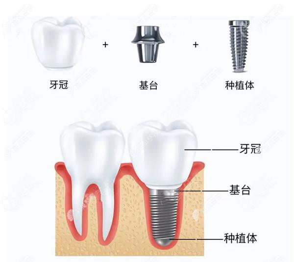 种植牙由种植体、牙冠和基台三部分组成