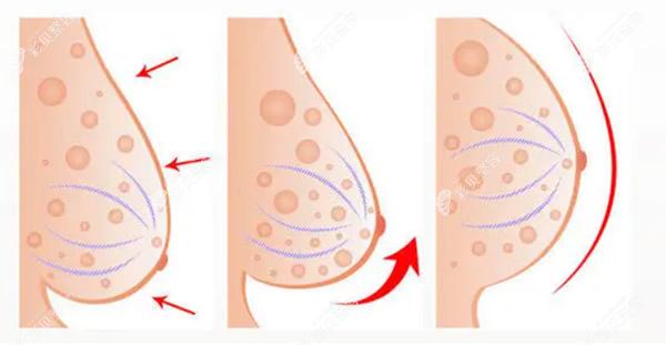 然禧医院乳房下垂提升照片 然禧医院乳房下垂提升照片