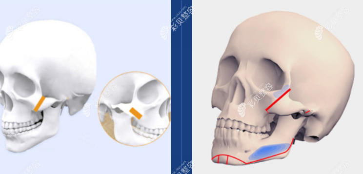北京圣嘉新颧骨内推