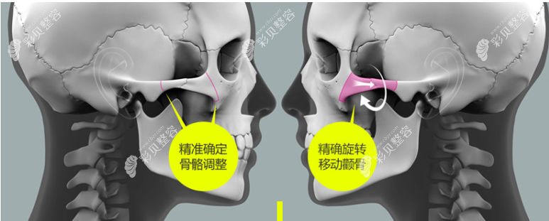 北京圣嘉新磨骨