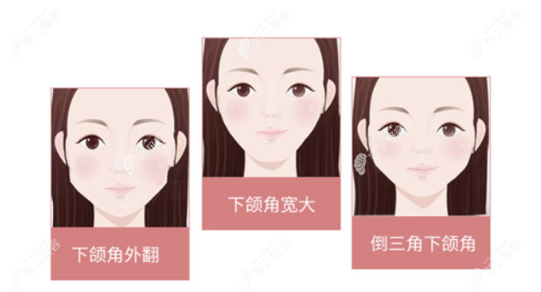 武汉亚韩整形医院赵贵庆做下颌角截骨怎么样