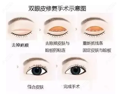 双眼皮修复宽改窄原理