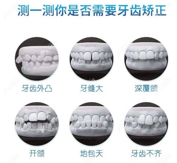 维乐口腔分享牙齿矫正适合哪些人做