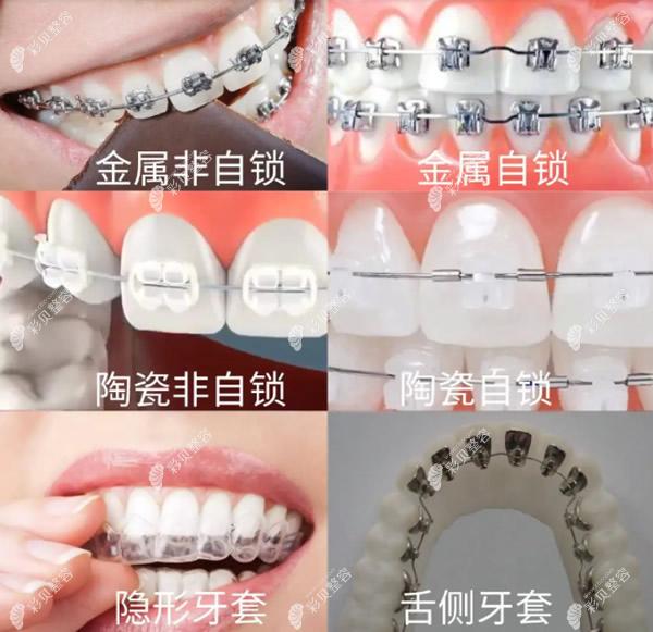 维乐口腔矫正牙齿常用的材料和正畸方法