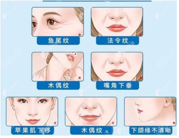 北京颂仪面部拉皮除皱怎么样