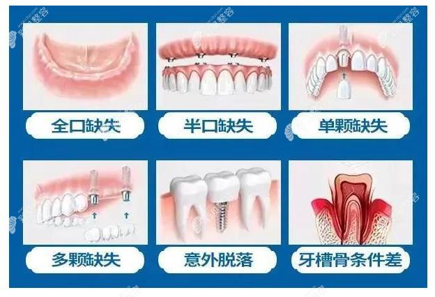 广州中家医口腔种植牙价格多少钱一颗