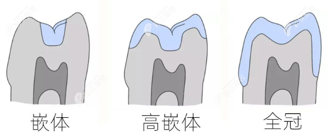 嵌体牙和全牙冠优缺点区别对比 嵌体牙和全牙冠优缺点区别对比
