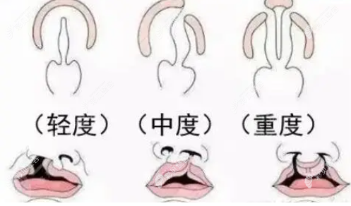 唇腭裂要做多少次手术