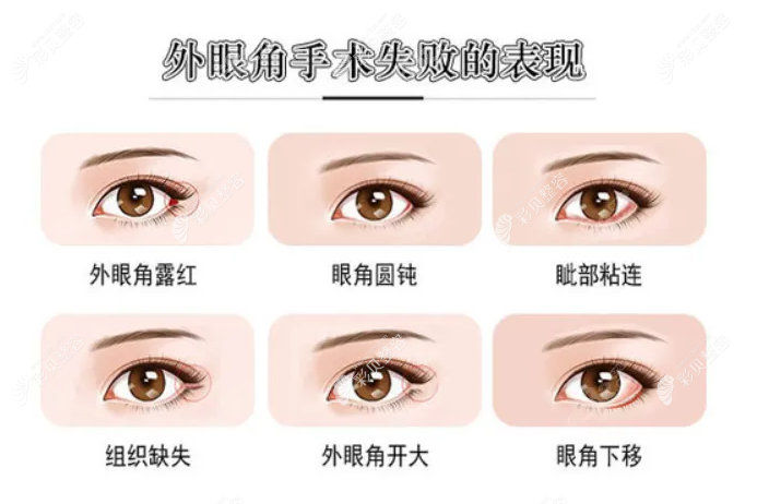 张冰洁修复外眼角价格