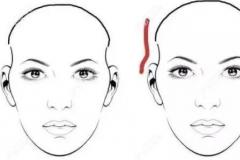颧骨突出脸颊凹陷，做颧骨内推可以改善面颊部凹陷吗？