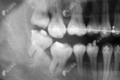 右侧六号牙缺失可以矫正智齿代替吗？费用大概需要多少钱?