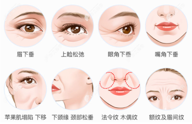 埋线提升和微拉美除皱区别有哪些 埋线提升和微拉美除皱区别有哪些