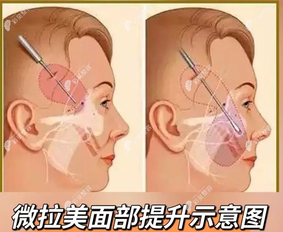 微拉美面部提升示意图 微拉美面部提升示意图