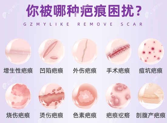 激光祛疤能淡化到几乎看不见吗www.cbzr.com 激光祛疤能淡化到几乎看不见吗www.cbzr.com