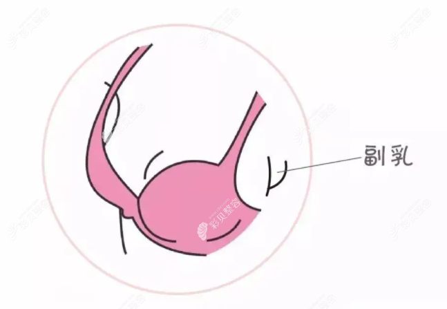 副乳切除是小手术吗