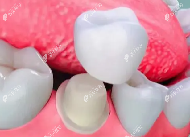 牙冠补牙怎么样 牙冠补牙怎么样