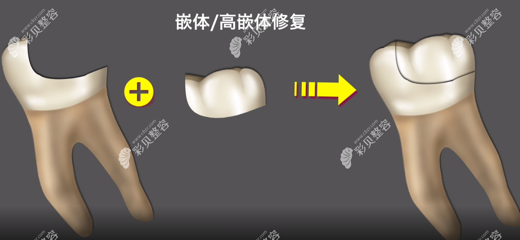 嵌体补牙过程图解 嵌体补牙过程图解