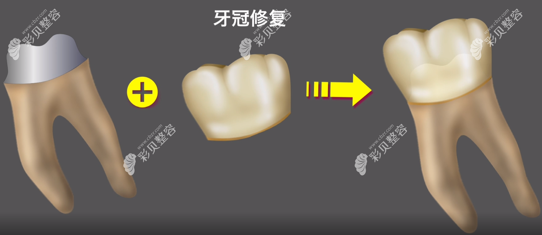 嵌体补牙和牙冠补牙价格哪个贵 嵌体补牙和牙冠补牙价格哪个贵