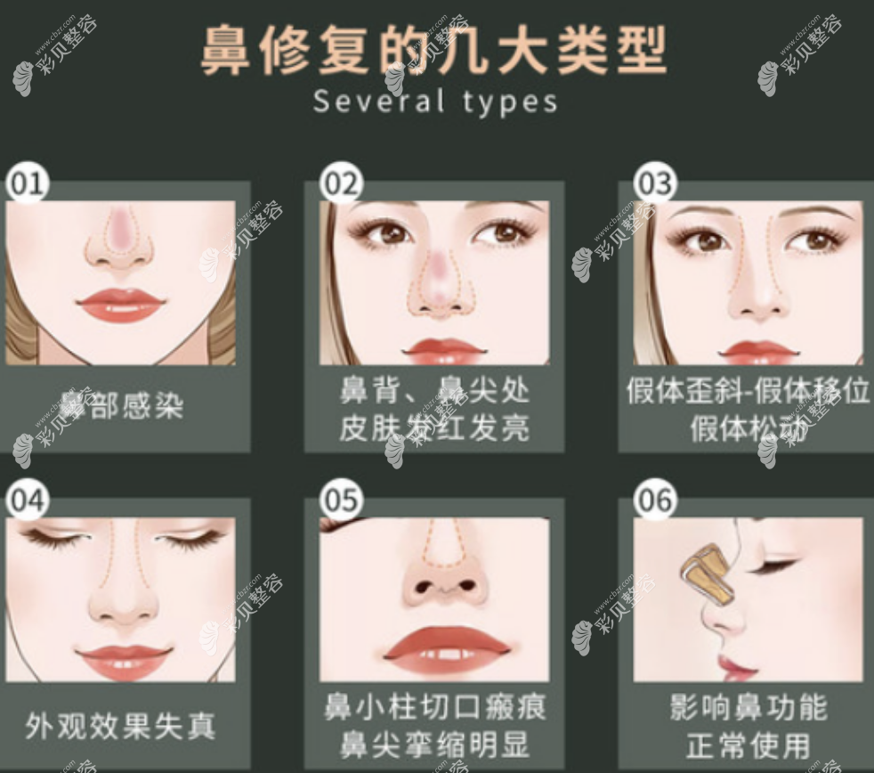 修复耳软骨鼻综合假体还能继续用吗www.cbzr.com