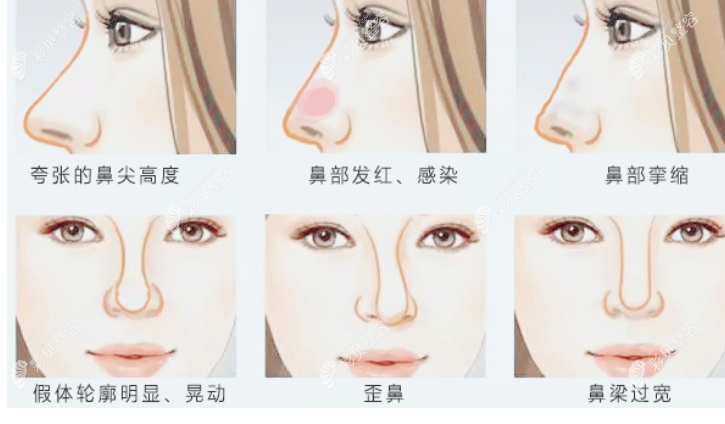 隆鼻失败图片