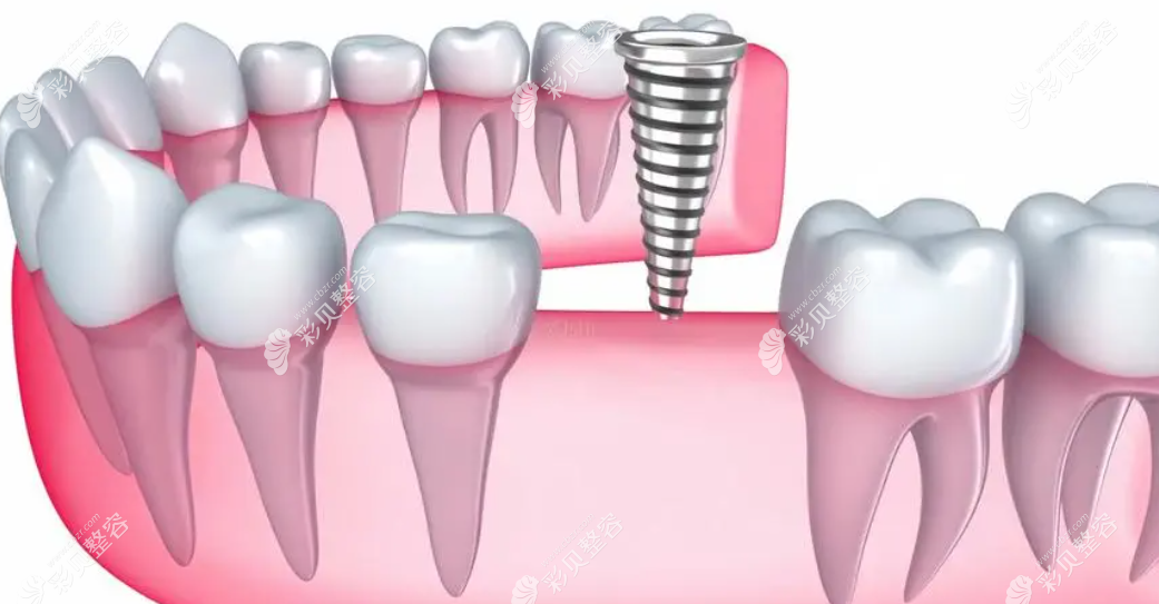 南京睿白口腔种植牙怎么样
