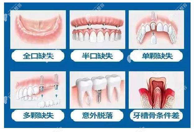 重庆任彬医生种植牙技术怎么样 彩#贝网